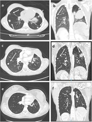 Clinical, Genetic, and Prognostic Features of Adrenocortical Tumors in Children: A 10-Year Single-Center Experience